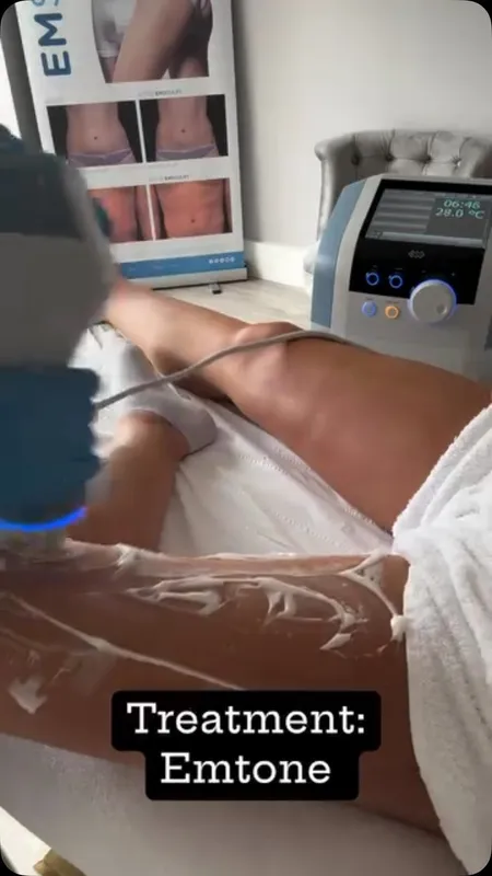 The EmTone applicator in use during a cellulite treatment at the clinic