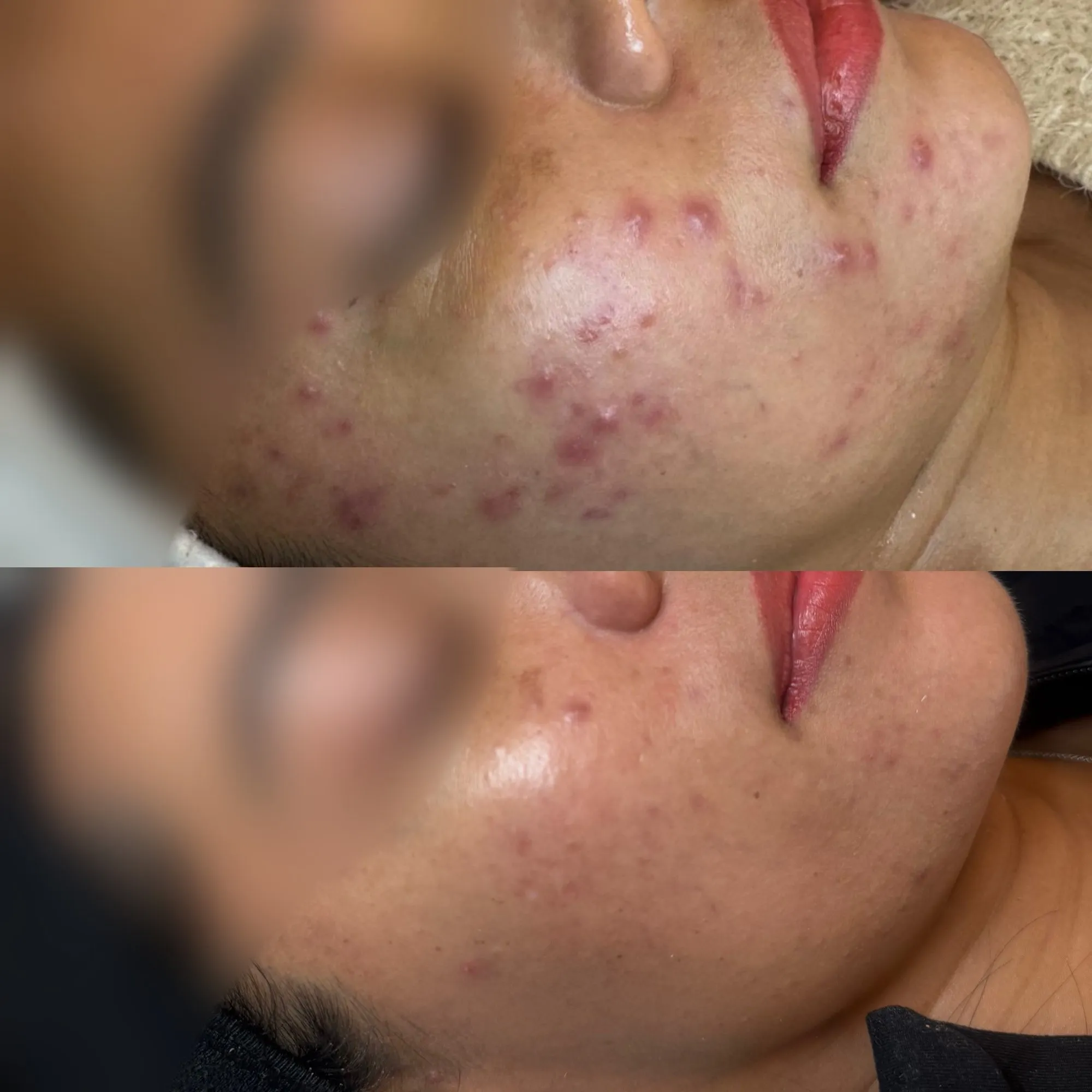 Cheek and chin with scattered red acne spots, and below it the same area with fewer, less inflamed spots.