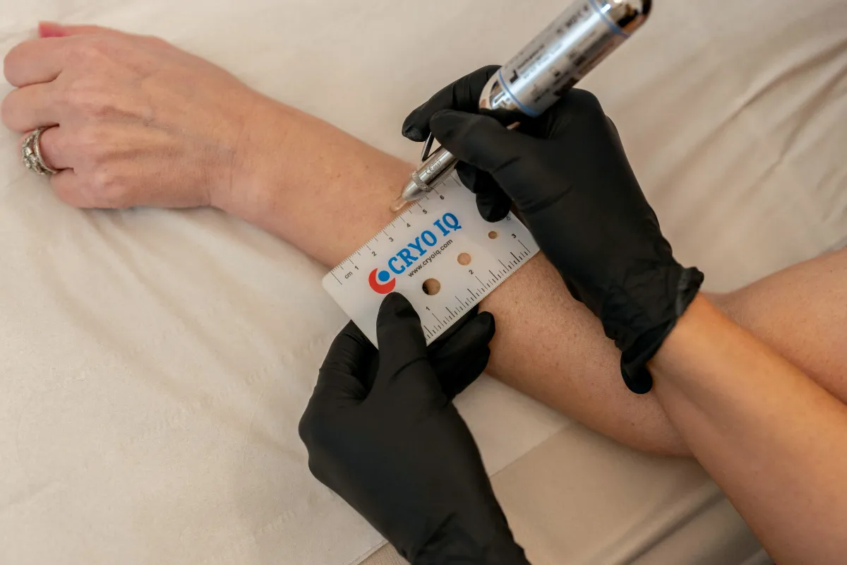 Cryotherapy Skin Tag & Lesion Removal at The London Road Clinic