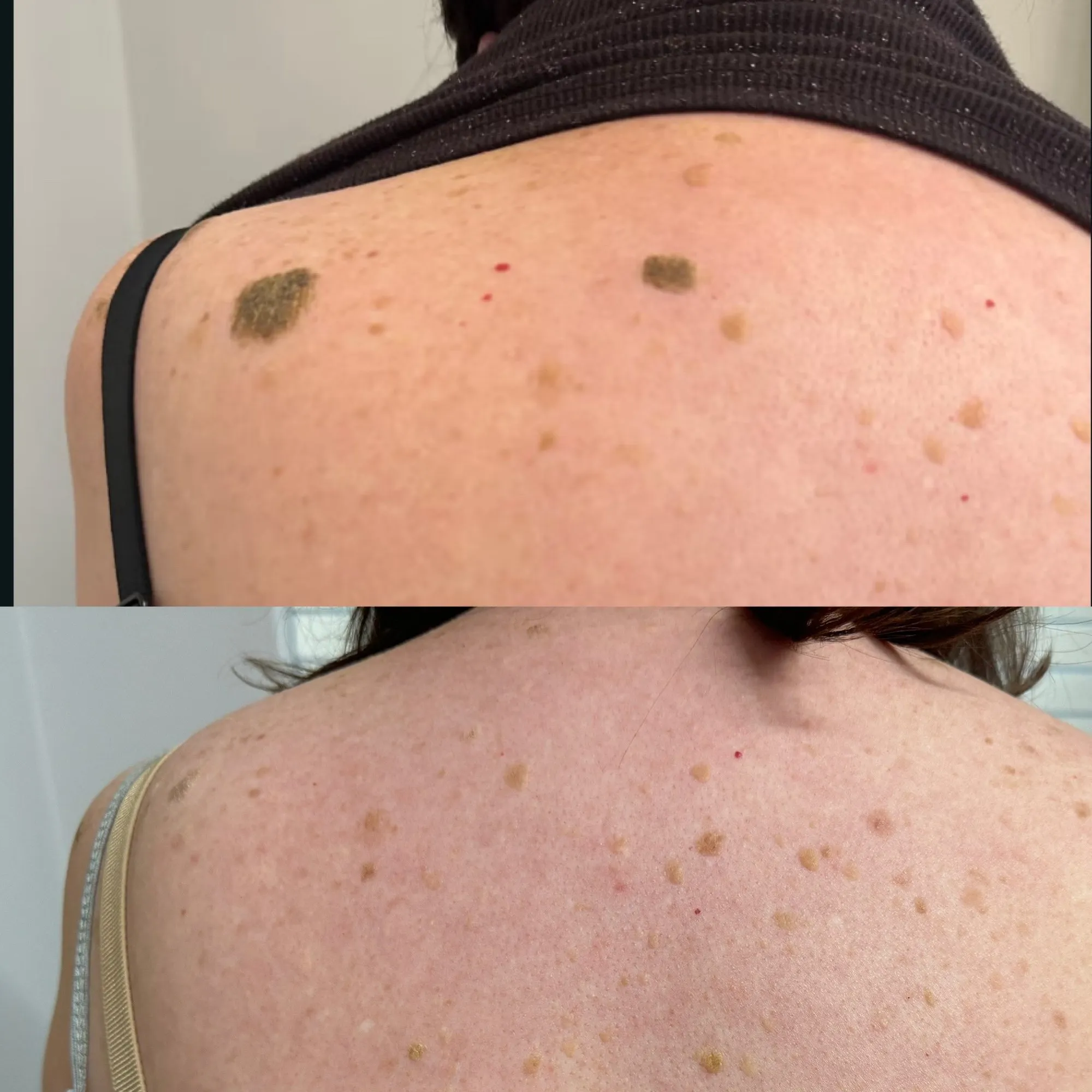 Upper back with two larger raised brown lesions among smaller marks, and below it the same back with the two larger lesions gone.