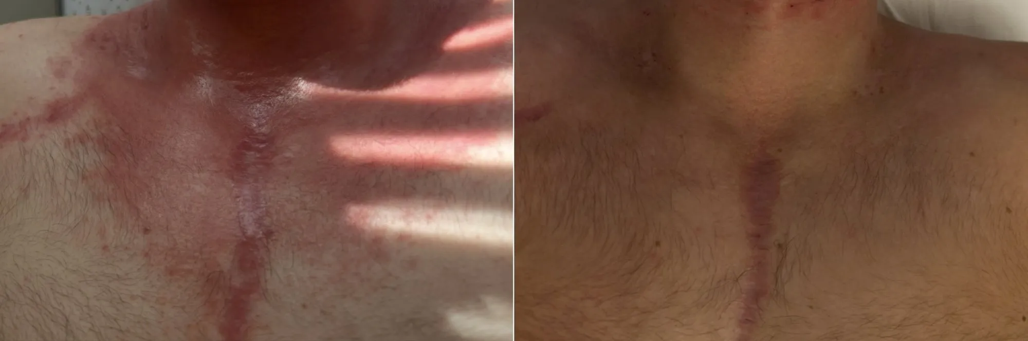 Upper chest with a broad band of red, inflamed skin, and beside it the same area with a narrow, faded mark.