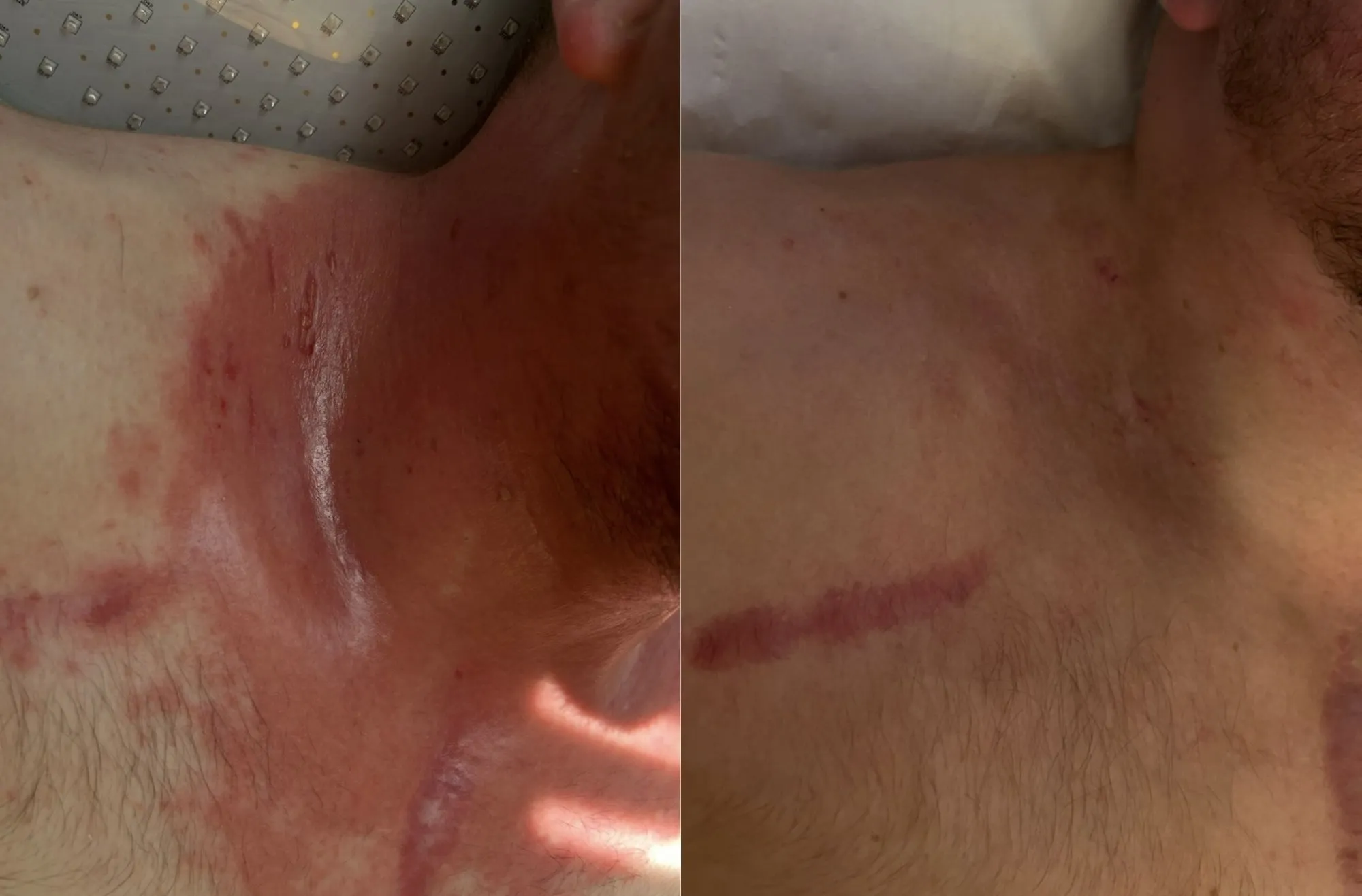 Neck and upper chest with raw, red inflamed patches, and beside it the same area with one faded line remaining.