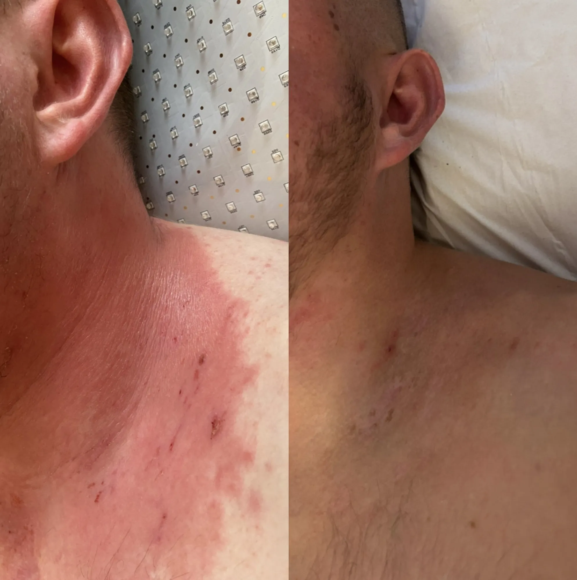 Side of the neck with widespread red, inflamed skin, and beside it the same area with close to even skin tone.