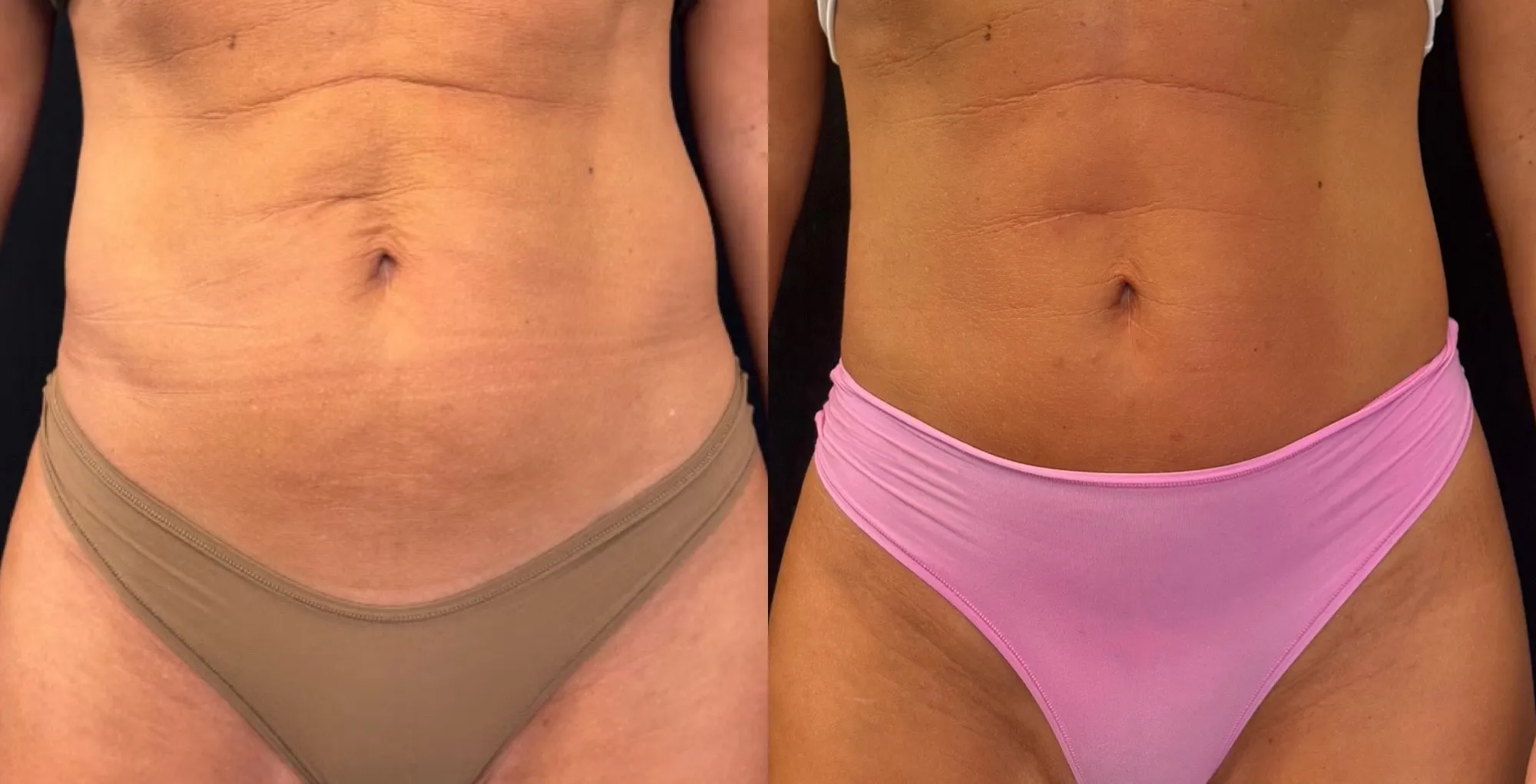 Front view of the abdomen with loose, creased skin, and beside it the same abdomen with smoother skin.