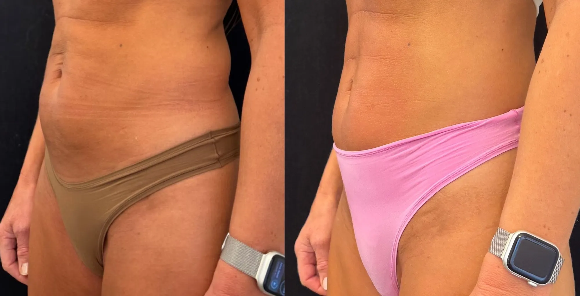 Side view of the abdomen and hip with creased skin, and beside it the same area with smoother skin.