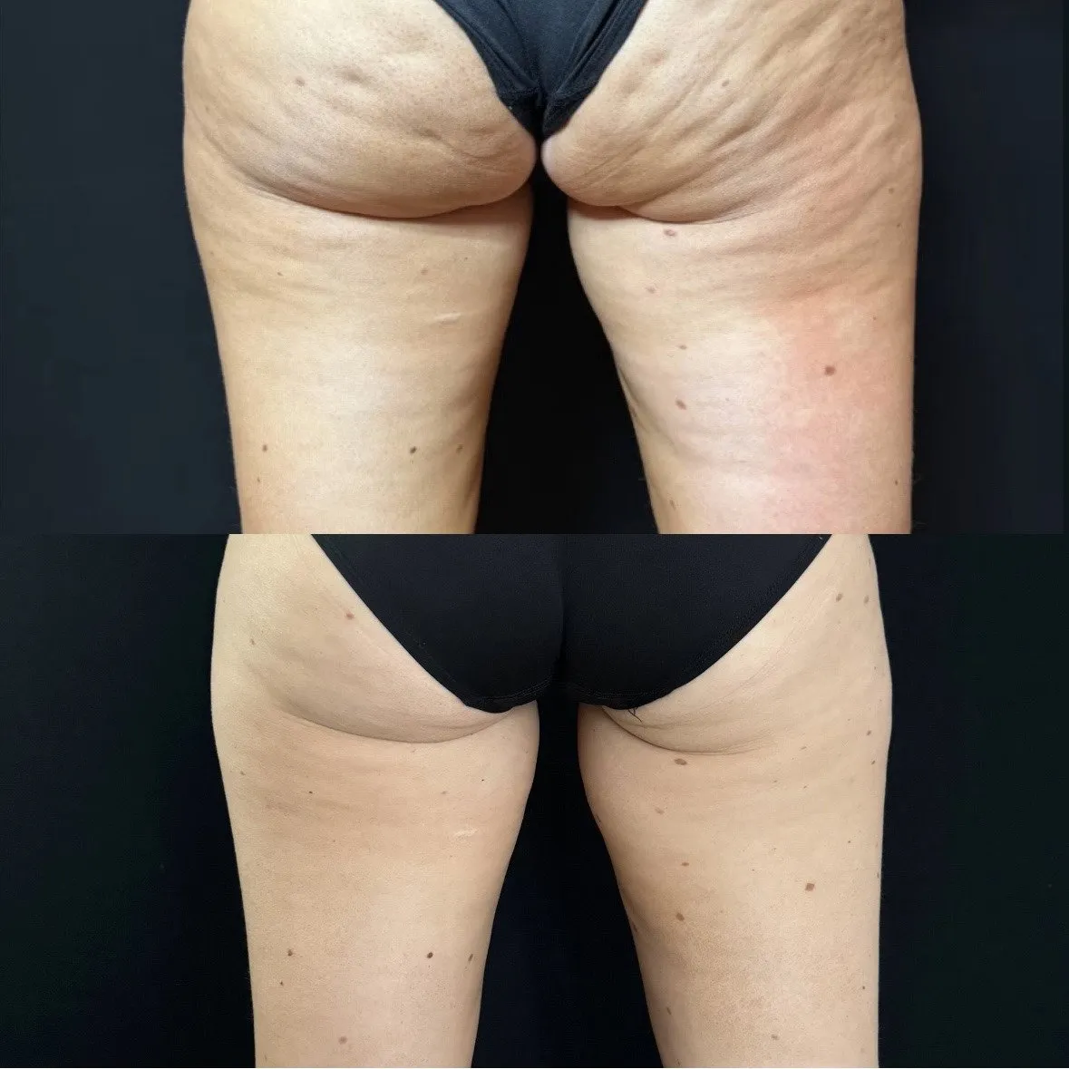 Back of the buttocks and upper thighs with dimpled cellulite, and below it the same area with smoother skin.