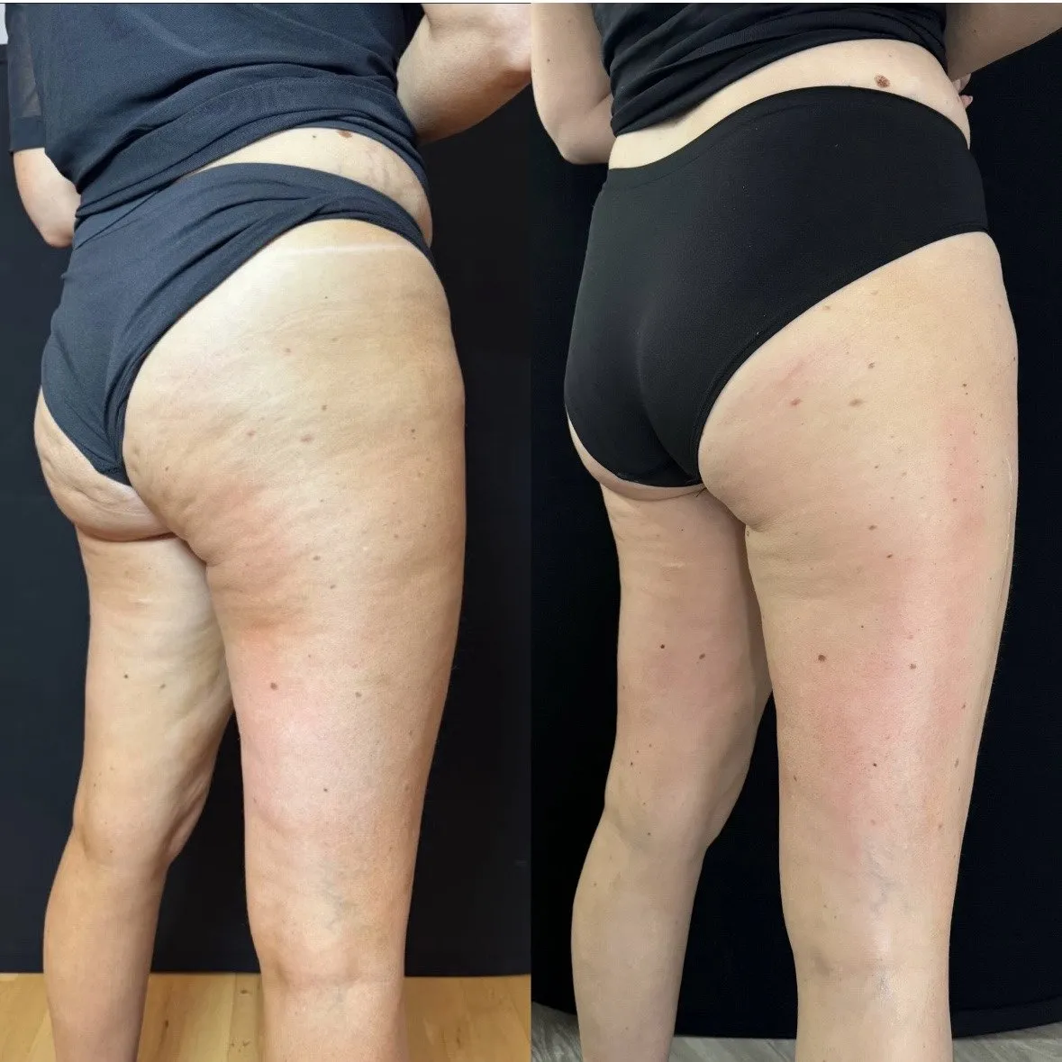 Side view of the buttock and thigh with dimpled cellulite, and beside it the same area with smoother skin.