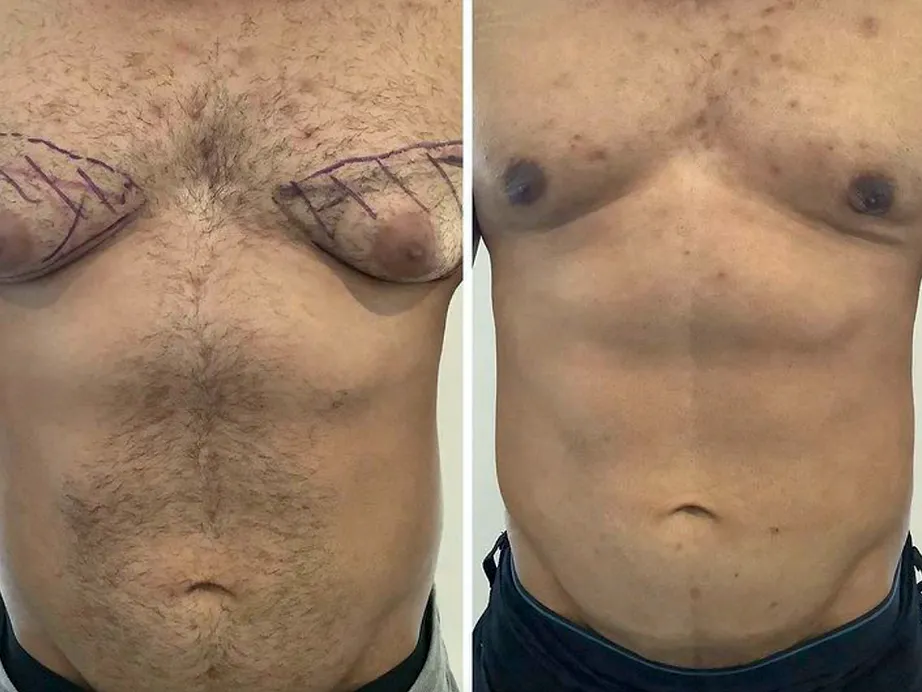 Gynecomastia Consultation at The London Road Clinic, Newark