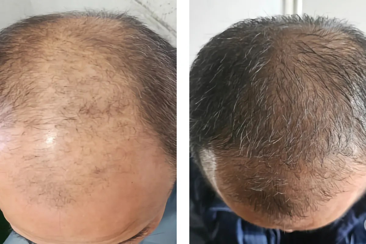 Hair Restoration Solutions at The London Road Clinic, Newark