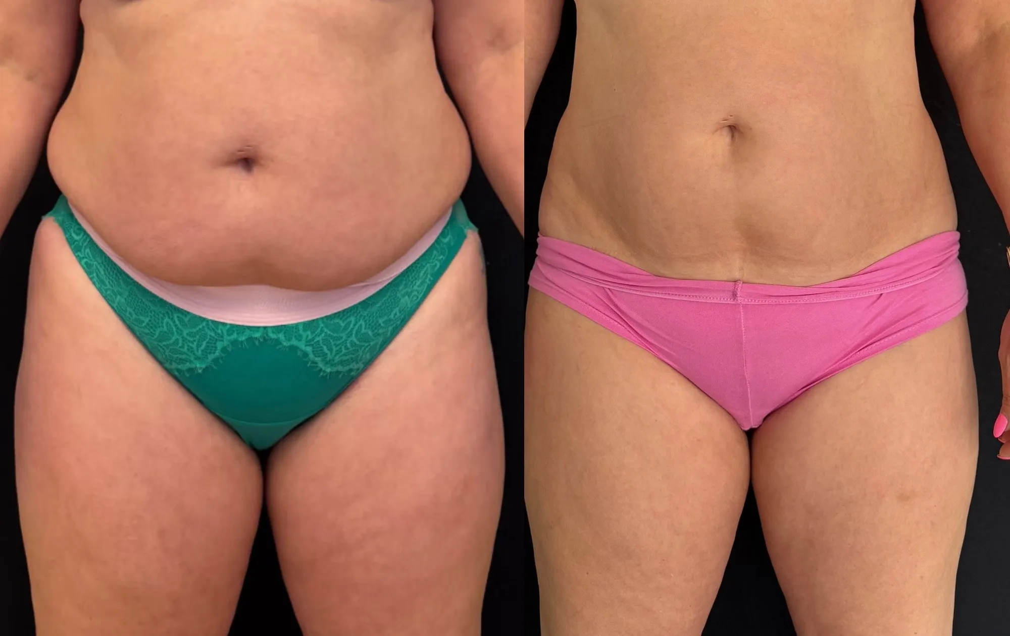 Front view of the abdomen and hips, and beside it the same area with a flatter, more defined waist.