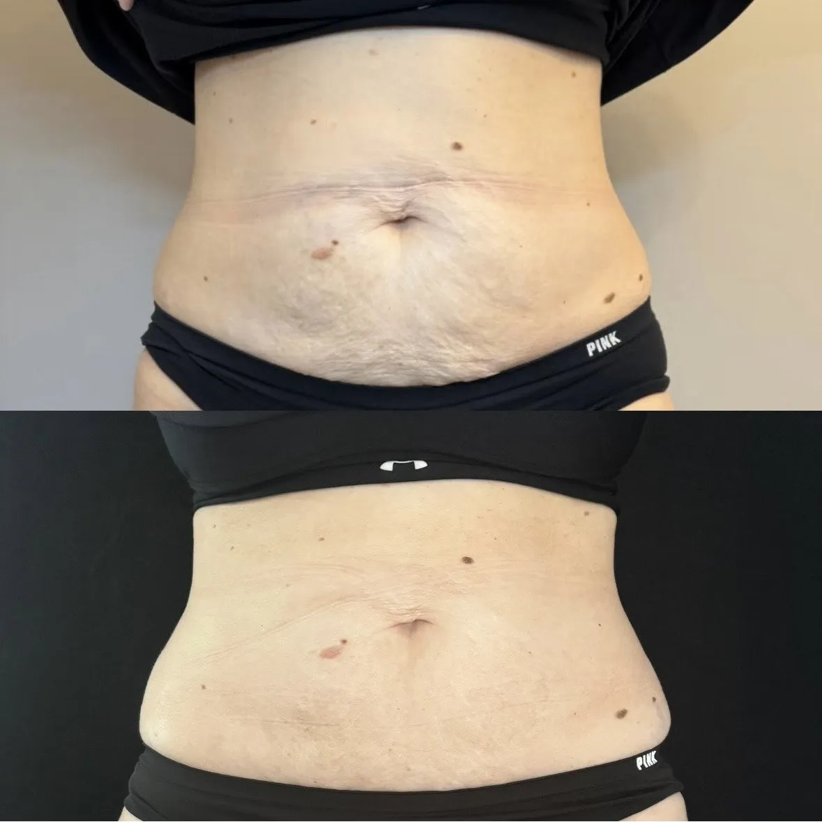 Front view of the lower abdomen with loose, creased skin, and below it the same abdomen looking flatter and smoother.