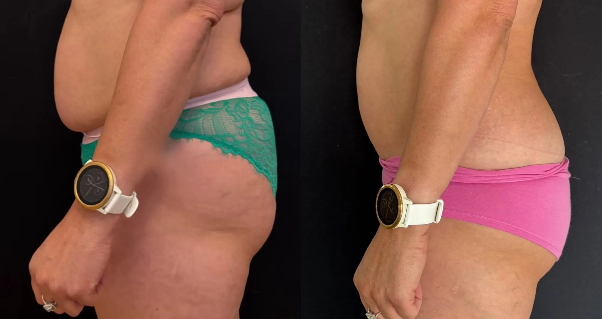 Side view of the abdomen and hip, and beside it the same area with a flatter stomach profile.
