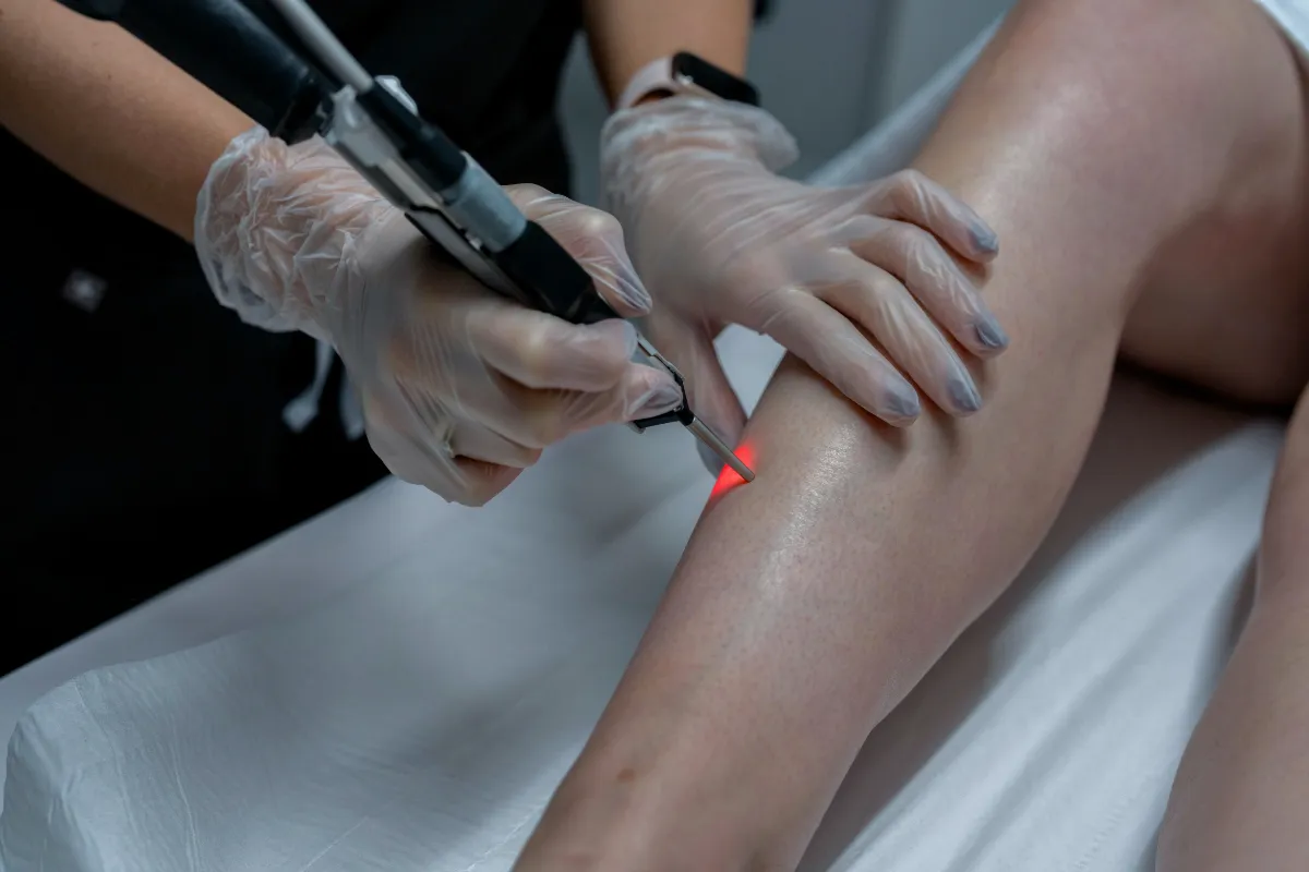 Laser Hair Removal (Cynosure) at The London Road Clinic