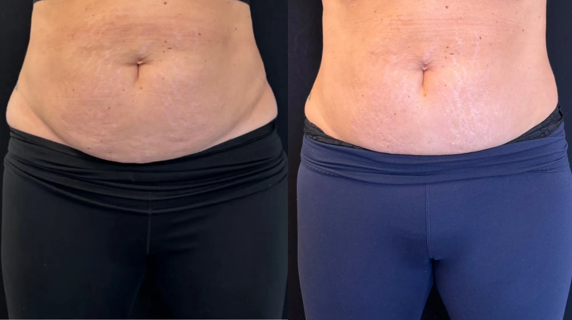 Front view of the abdomen above the waistband, and beside it the same abdomen looking flatter.