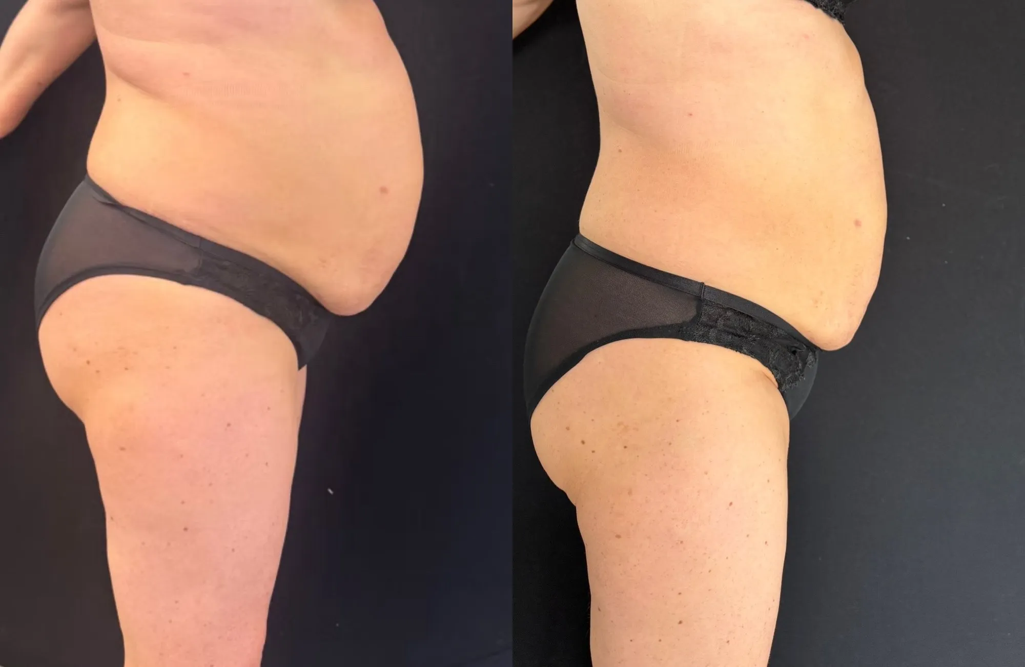Side view of the abdomen and buttock, and beside it the same area with a smaller stomach profile.