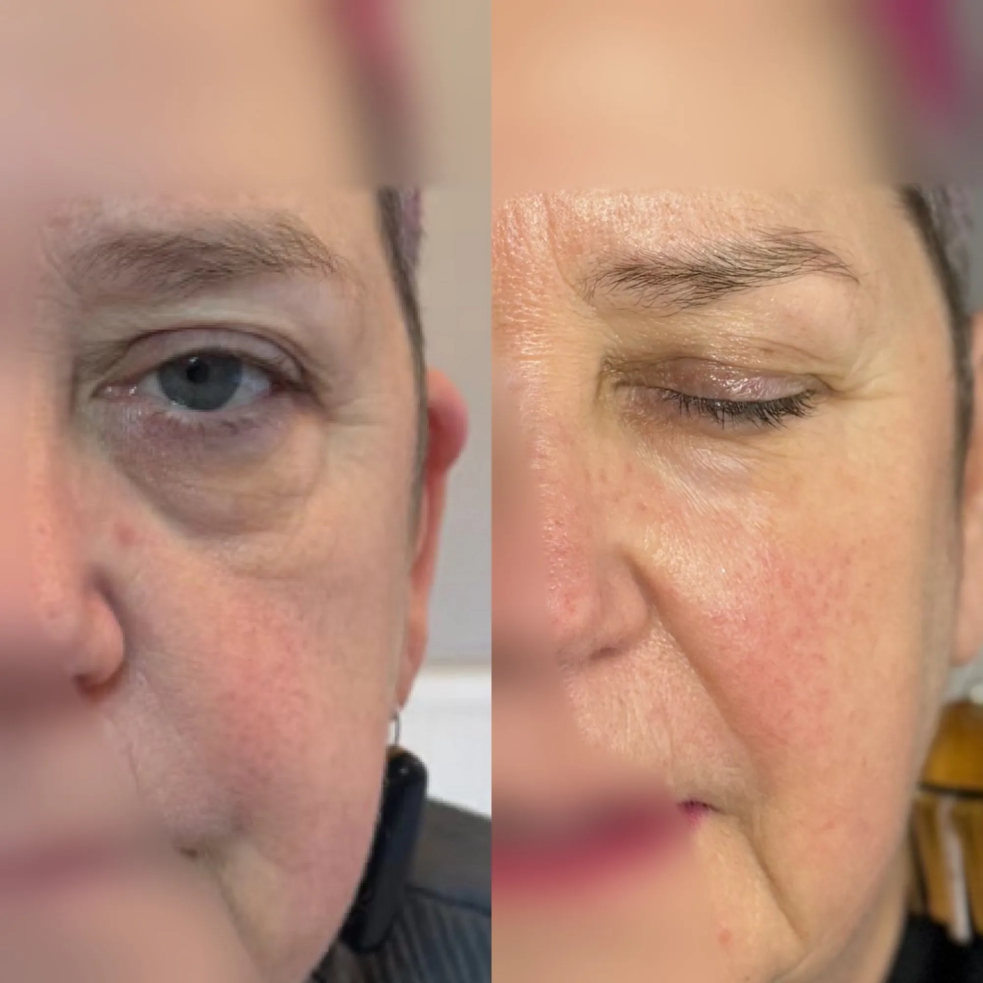 Under-eye area with darkness and fine creasing, and beside it the same area looking brighter and smoother.