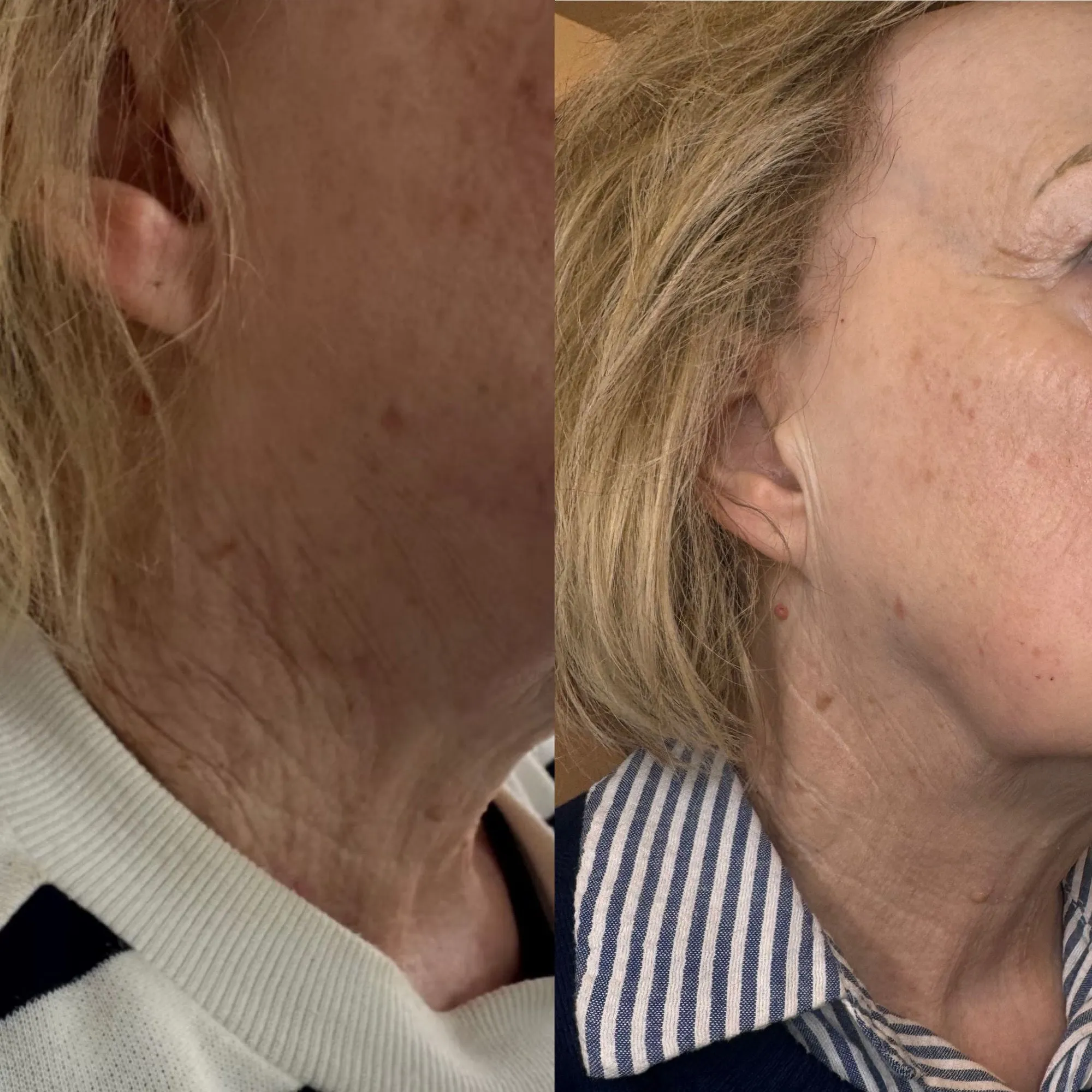 Side of the neck with crepey, lined skin, and beside it the same neck with smoother skin.