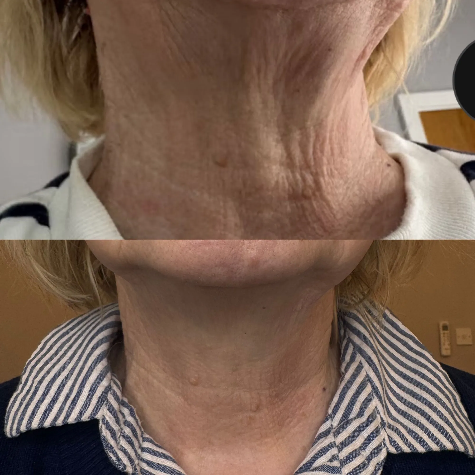 Front of the neck with deep crepey lines, and below it the same neck with softer, smoother skin.