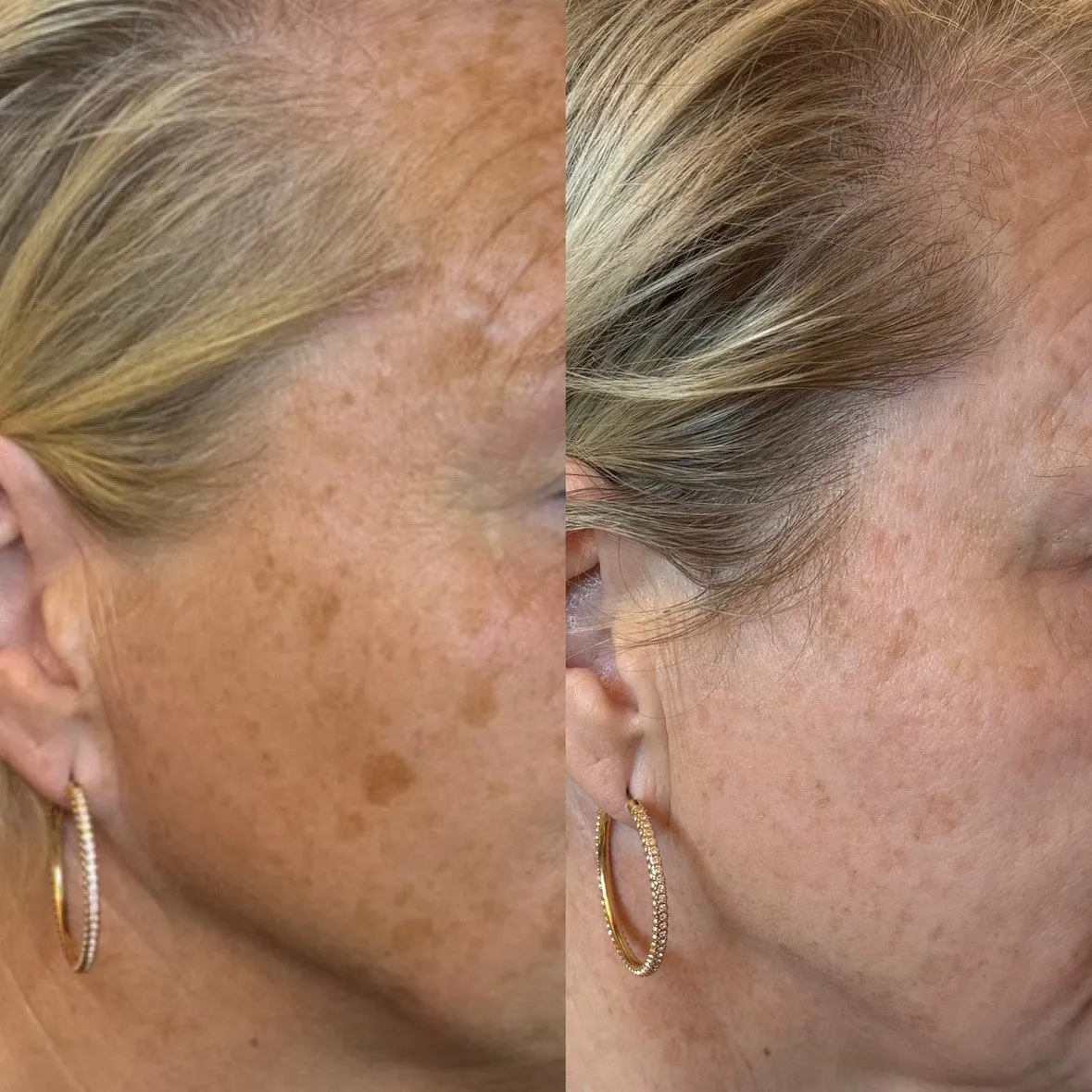 Cheek and temple with uneven skin texture, and beside it the same area with smoother texture.
