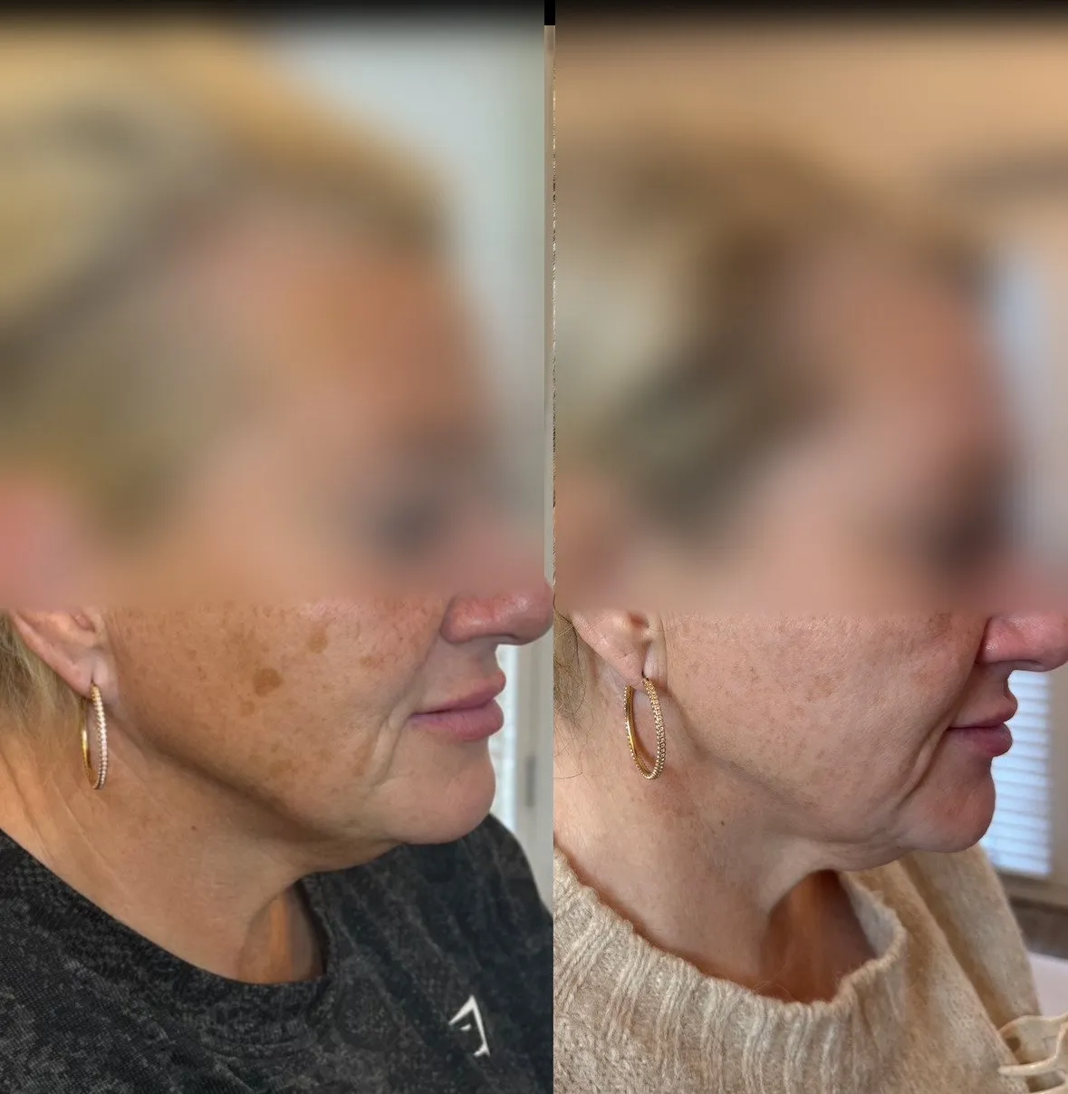 Profile of the lower face and jaw, and beside it the same profile with smoother skin texture.
