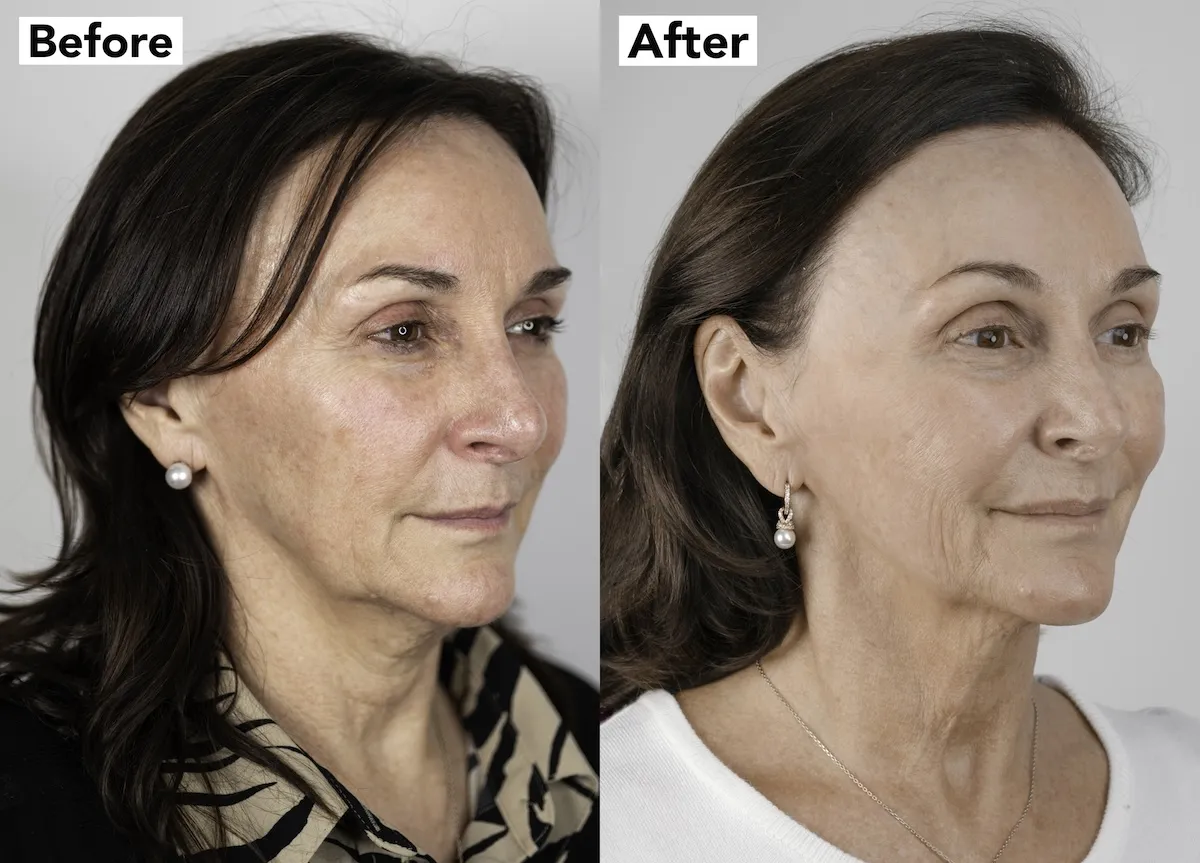 Shirley Ballas before and after NeoGen plasma treatment