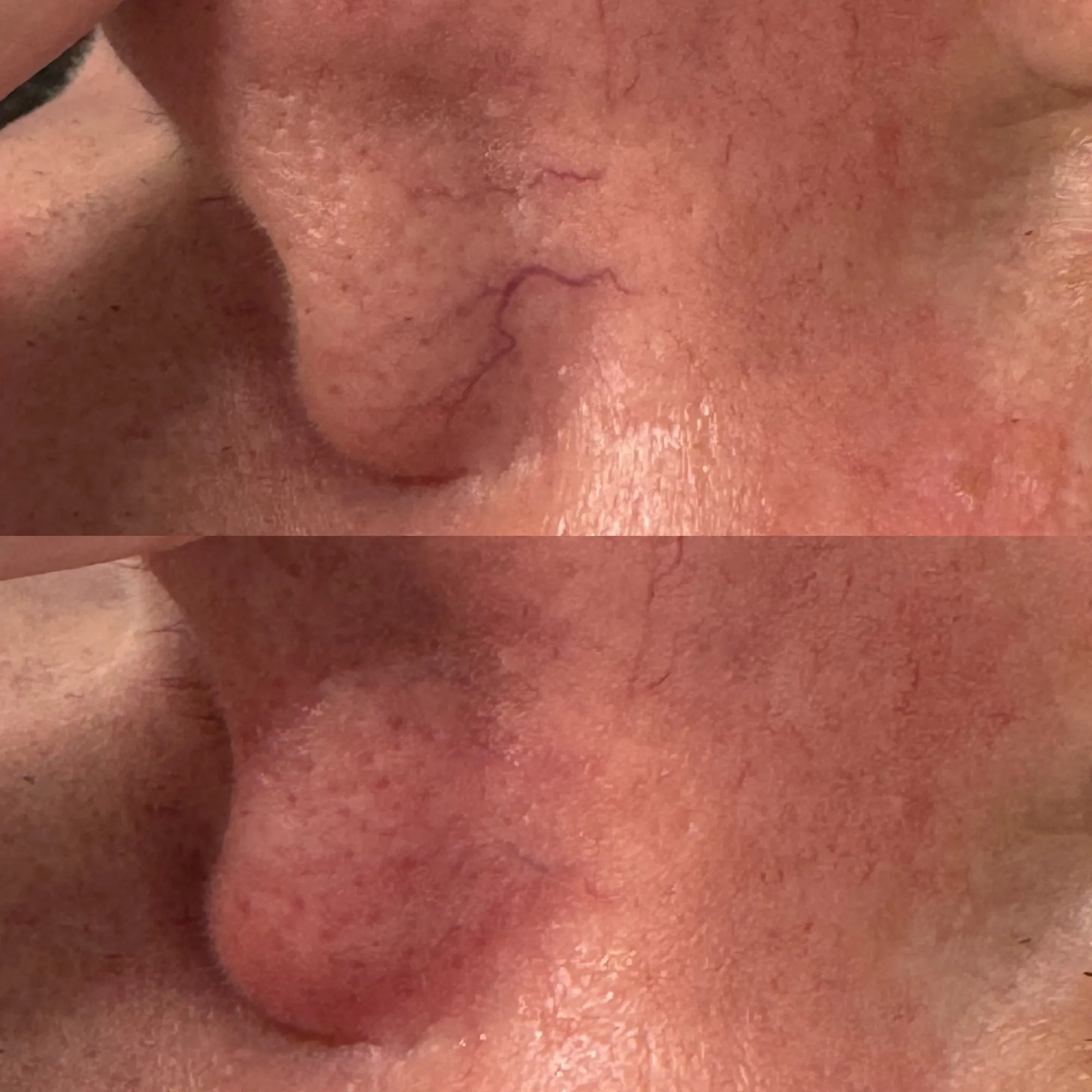 Side of the nose with fine visible thread veins, and below it the same area with the veins no longer visible.
